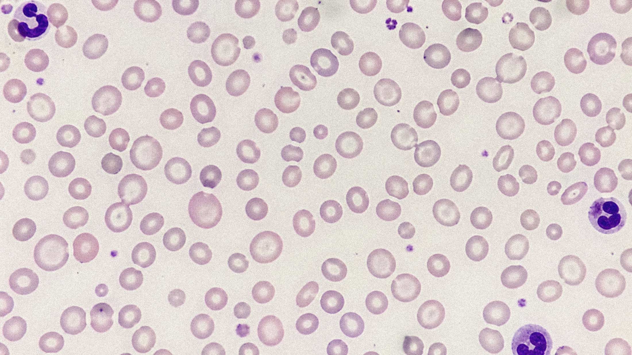 AnemiaVision Turns Two Phone Photos Into a Blood Test Alternative